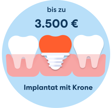 Kosten Implantat mit Krone