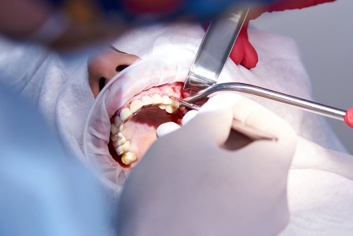 Beim Sinuslift baut der Zahnarzt den schwindenden Knochen zum Teil wieder auf.