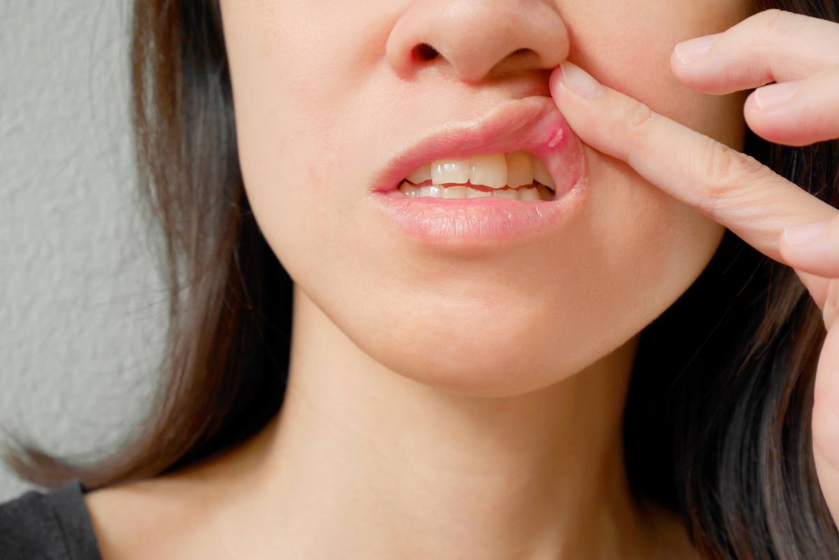 Bei Kindern tritt häufig eine Stomatitis aphthosa, besser bekannt als Mundfäule, auf.