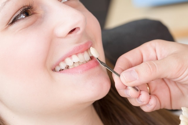 Veneers für Ihre Zähne: Zahnlücken, schiefe Zähne und Verfärbungen lassen sich damit kaschieren.
