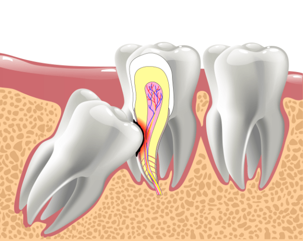 Weisheitszahn drückt auf Nerv des Zahns davor bzw. schädigt diesen.