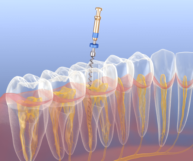 Mit einer Zahnwurzelbehandlung kann Ihr Zahnarzt einen im Inneren geschädigten Zahn oftmals retten.