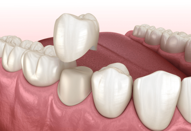 Zahnkronen - warum eine Behandlung schnell teuer werden kann und sich eine Zahnzusatzversicherung lohnt