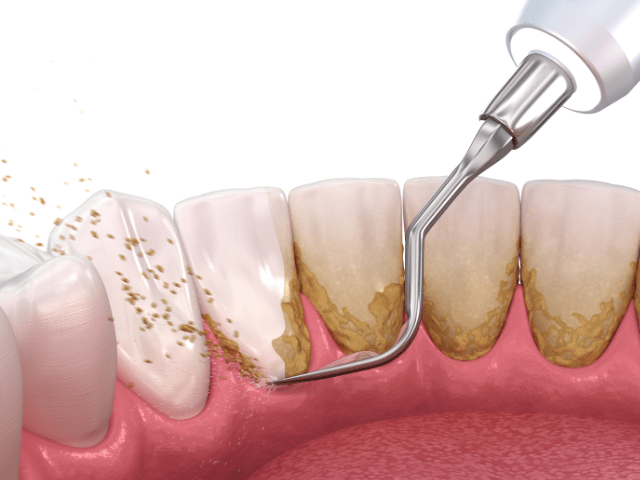 Zahnstein vorbeugen: Eine regelmäßige Mundpflege schützt vor harten Zahnbelägen.