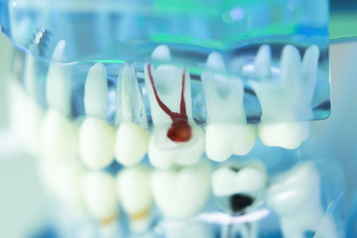 Zahnwurzelentzündung Diese Symptome deuten darauf hin