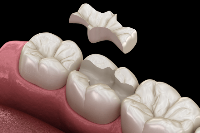 Inlays für die Zähne: eine hochwertige Alternative zu einfachen Zahnfüllungen aus Kunststoff.