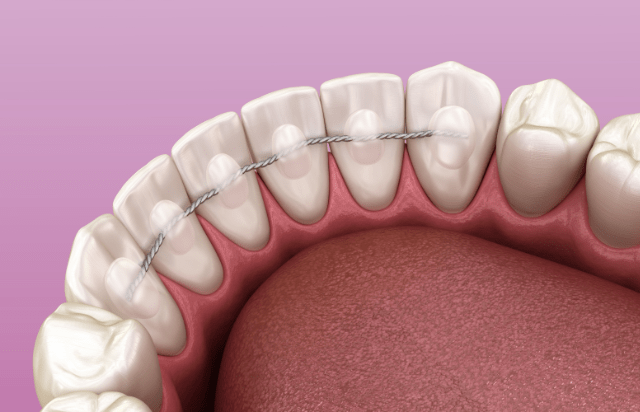 Retainer garantieren langfristig den Erfolg einer kieferorthopädischen Behandlung.