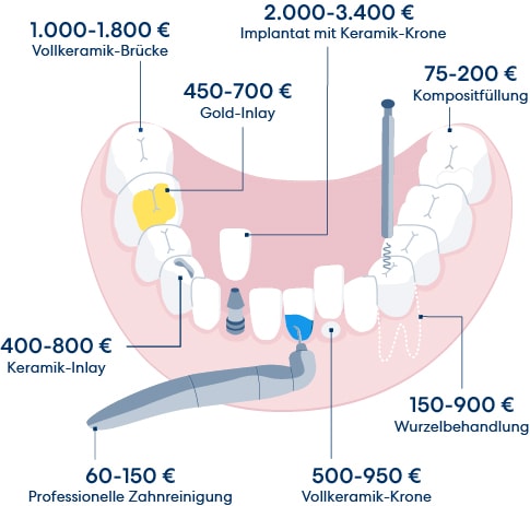 Beispiele für teure Zahnbehandlungen – abgedeckt durch die Zahnzusatzversicherung