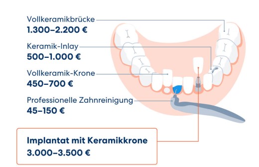 Kostenübersicht ohne Versicherung - Zahnversicherung DA Direkt