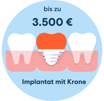 Kosten Implantat mit Krone