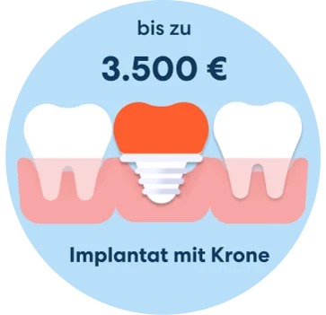 Kosten Implantat mit Krone