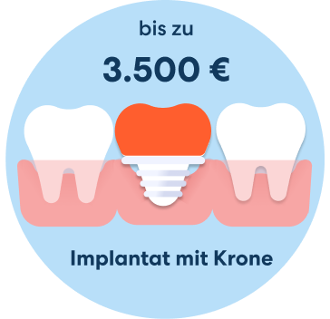 Kosten Implantat mit Krone